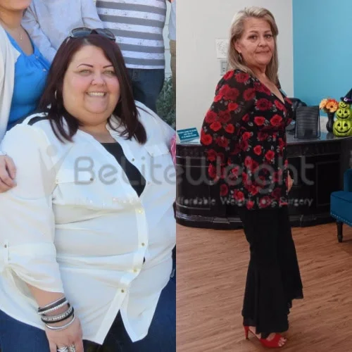 RNY Gastric Bypass Before and After Weight Loss Surgery Before and After